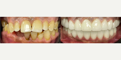 Dental Crowns - Question: When is a dental examination done?Oral and dental health is important in terms of body health, although a dental examination is done when there are any complaints. In this context, dental examination should be undergone at regular intervals. If routine dental check-ups are neglected, many diseases, especially dental decays, occur.Question: When is the first dental examination in children performed?In children, it is necessary to take them to the dental examination for the first time when the tooth comes out. It is necessary for dental health to check milk teeth by a dentist. Depending on whether there is any problem, the dentist will guide about when to go for a check-up.Question: What is Oral Diagnosis?Oral diagnosis is the branch that examines the diagnosis and treatment criteria of diseases related to the mouth, teeth and gums. Developmental defects and anomalies are also covered by this area.Oral diagnosis is divided into two main groups as intraoral and extraoral diagnosis. Basic scientific studies are handled in four groups.Description of symptomsDescription of syndromesDiagnostic methodsDetermination of laboratory  radiological  pathological applications leading to the diagnosisQuestion: How Is Tooth Filling Made?After the tooth tissue is prepared for filling, the teeth cavities are cleaned. After this process, the appropriate material is selected according to the function of the tooth in the mouth. Local anesthesia is required so that the patient does not feel any pain while the filling is being performed. In the last stage, it is checked whether the filling is compatible with the teeth.Question: Impacted teeth should be extracted in certain situations. These situations can be listed as follows;Presence of semi-impacted teeth that have caused gum infectionPresence of teeth that compress adjacent teeth and cause painRisk of cyst formation around the impacted toothOrthodontic reasonsQuestion: How long is the life of tooth with a root canal treatment?The root canal treated tooth can stay with you for a lifetime if the necessary sensitivity is shown by giving importance to oral and dental hygiene, not disrupting the doctors controls.
