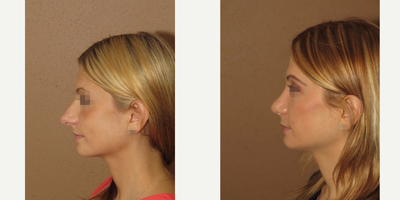 25-34 year old woman treated with Rhinoplasty - 1 year after surgery, rhinoplasty