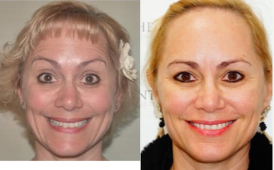 45-54 year old woman treated with DefenAge - 45-54 year old woman treated with DefenAge