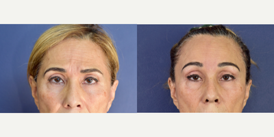 55-64 year old woman treated with Brow Lift, Canthoplasty, Facial Fat Transfer - Female patient with periorbital and forehead aging process. Dr. Valdez performed an endoscopic browlift  (minimal invasive surgery) with craneal fixation with Endotine. Forehead rejuvenation were performed with corrugator and procerus muscles released. Dr. Valdez improve her eye shape with lateral canthoplasty and facial fas grafting with micro and nonofatgrafting.