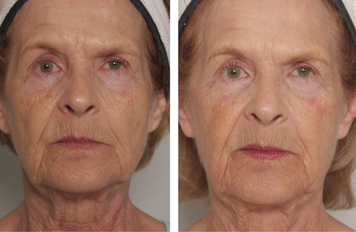 55-64 year old woman treated with Pearl Laser - Laser Pearl Treatment