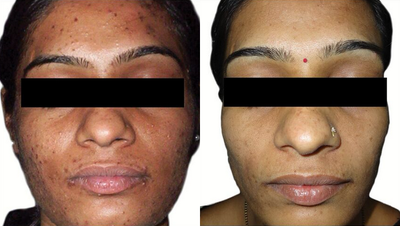 Venus Viva - Before and After 6 Treatments. &nbsp;Photos provided courtesy of Venus Concept, performed by Megha Joy Shah, MD.
