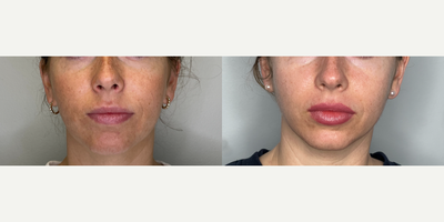25-34 year old woman treated with Microneedling, Chemical Peel - patient was treated with microneedling and vi peel