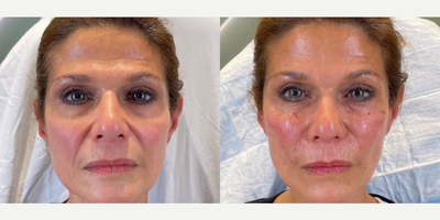 Woman treated with Facial - Woman treated with Facial