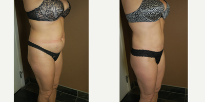 25-34 year old woman treated with Mini Tummy Tuck - mini tummy tuck and liposuction