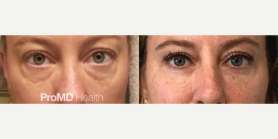 Woman treated with Hyaluronidase, Sculptra - Woman treated with Hyaluronidase, Sculptra