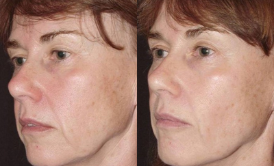45-54 year old woman treated with Thermage - 3 months after Thermage treatment