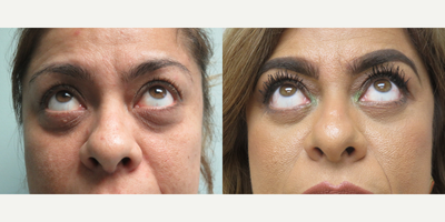 45-54 year old woman treated with Eyelid Surgery - This patient had rejuvenation to her lower eyelids by a lower lid Blepharoplasty with Canthopexy