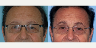 69 year old man treated with Eyebrow Transplant and Frontal Hairline Transplant - Patient with aging hypotrychia of the brows, had permanent make up done years ago and wanted help restoring his brow and covering up the tattoo work. 6 months post op. Also performed frontal hair line transplants at the same time to improve the density of his hair line. Hair will continue to grow for the next 6 months as he is currently at 70% of expected result.