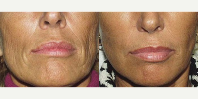 Liquid Facelift - Liquid Facelift