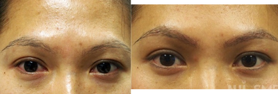 25-34 year old woman treated with Eyebrow Transplant - This is how an eyebrow transplant looks like 7 days after.  You can go back to work without issue.