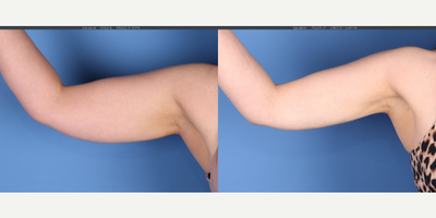33 year old woman treated with Arm Liposuction, Power-Assisted Liposuction (PAL) - Liposuction of arms