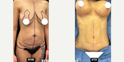 25-34 year old woman treated with Tummy Tuck, Liposuction, Breast Lift - 25-34-year-old woman treated with Tummy Tuck, Back Liposuction, Breast Lift  Her main concerns were the excess skin and fat around her abdomen and address the droop to her breasts.