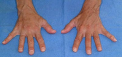 45-54 year old woman treated with Hand Rejuvenation - Procedure: Fat injection of hands