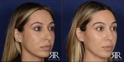 35-44 year old woman treated with Rhinoplasty - Rhinoplasty