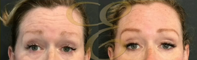 Woman treated with Botox - Woman treated with Botox