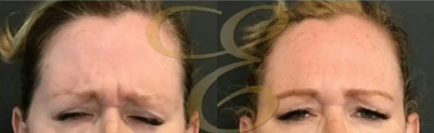 Woman treated with Botox - Woman treated with Botox