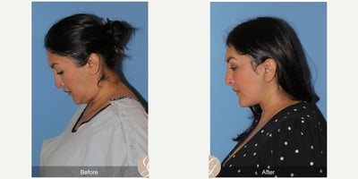 47 year old woman treated with Deep Plane Facelift, Neck Lift, Brow Lift, Buccal Fat Removal, MACS Facelift - 47 year old woman treated with Deep Plane Face and Neck Lift, Temporal Brow Lift, Buccal Fat Extraction, MAC