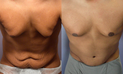 Male Body Contouring - 
	Male Body Contouring (case 1998)
