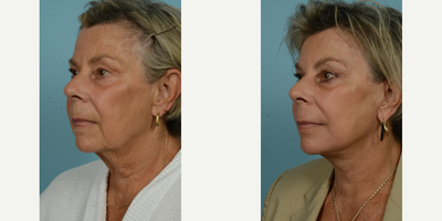 65-74 year old woman treated with Facelift, SMAS Facelift, Neck Lift, Eyelid Surgery, Brow Lift, Facial Fat Transfer, Laser Resu - At the vibrant age of 71, this patient elected to undergo several procedures with Dr. Thomas Mustoe to preserve her natural beauty and active lifestyle without an overly tight or pulled appearance. Her personalized facial rejuvenation included a deep plane facelift/minilift, neck lift, upper blepharoplasty, brow lift, and fat grafting around the mouth, all performed by the skilled hands of Dr. Mustoe in Chicago. Post-procedure results, observable just one month post-op, reflect her desire for a subtle but impactful alteration, enhancing her already attractive features while maintaining her characteristic expressions.The above patient sought to leverage Dr. Mustoe's proficiency not only in facelift/minilift techniques but also in neck lift, blepharoplasty, brow lift, and fat grafting procedures. In addition to these, laser treatment and dermabrasion were used to augment the smoothness and youthfulness of her skin near the mouth area. The successful outcome demonstrates Dr. Mustoe's commitment to meeting the patient's unique requirements. Despite her age, the patient continues to lead a vibrant life post-procedure, which highlights minimal impact on her active lifestyle due to Dr. Mustoe's careful and thoughtful approach.Known for his personalized approach and optimal results, Dr. Thomas Mustoe is an American board-certified plastic surgeon and a respected authority in the field. Renowned for conducting over 10,000 operations, Dr. Mustoe's practice, TLKM Plastic Surgery, located at 737 North Michigan Ave., Chicago, offers innovative and age-defying techniques, including the facelift/minilift procedure. The patient's experience showcases Dr. Mustoe's ability to balance surgical control and aesthetic sensitivity to deliver naturally beautiful results that satisfy the patient's desires while preserving their unique identity.