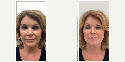 68 year old woman before and after Bellafill Injections - This is a woman who wanted to look more rested and rejuvenated. We opted to treat her with one kit of Bellafill and she is thrilled with her results! She is shown immediately before and after treatment.We are a BellaDiamond practice. A rare distinction that is reserved to the top 1% of Bellafill providers in the nation.