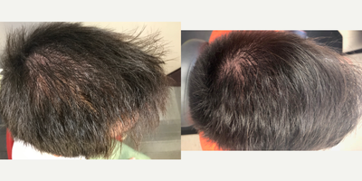 18-24 year old man treated with Low-Level Laser Therapy - 6 PRP Hair Restoration Treatments, combined with Low Level-Laser Therapy