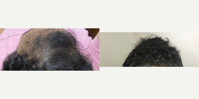 25-34 year old man treated with Low-Level Laser Therapy - 4 PRP Hair Restoration Treatments, combined with Low Level-Laser Therapy