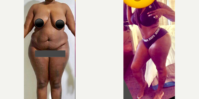 35-44 year old woman treated with Tummy Tuck, Liposuction - 35-44 year old woman treated with Tummy Tuck, Liposuction