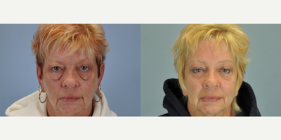 55-64 year old woman treated with Eyelid Surgery - This 62 year old patient was bothered by the bags under her eyes. She had bilateral upper and lower blepharoplasty, bilateral canthopexy, and endoscopic brow lift to achieve her desired result of a refreshed appearance.