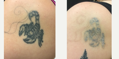 35-44 year old woman treated with Tattoo Removal, PicoSure - Before & After only 3 Sessions of Tattoo Removal using the PicoSure laser. This client didn't want complete removal because they are getting a cover-up tattoo, so our goal was to lighten the tattoos. After just 3 sessions there was significant reduction in the tattoo ink and she is excited to get her new tattoos.