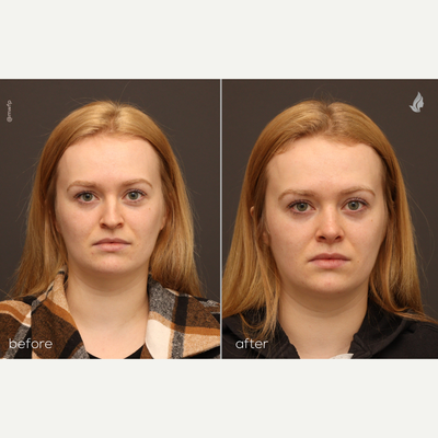 Rhinoplasty - 27 year old patient who is 1 months out from a rhinoplasty and can expect to see continued improvement in definition of the nasal tip