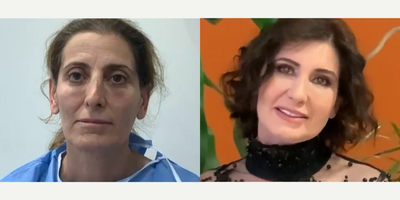 49 year old woman treated with Revision Rhinoplasty - 49 year old woman treated with Revision Rhinoplasty as well asMini Facelift,Brow Lift, Eyelid Surgery,and Facial Fat Transfer, shown 8 months post op. Pre-op, she did not find herself beautiful and felt that she looked very old.