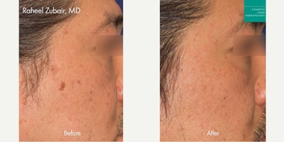 PicoWay Laser for Dark Spots by Dr. Zubair - PicoWay Laser for Dark Spots by Dr. Zubair
