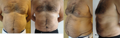 Liposuction-Gynecomasty  - Liposuction and gynecomasty