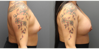 Breast Augmentation with Natrelle Breast Implants for this 33-year-old Woman - This 33-year-old female had breast augmentation with Natrelle Inspira (SRF-450) implants. She is 2 months recovered.