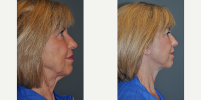 65-74 year old woman treated with Mini Lift - This patient had a Mini face lift with CO2 laser resurfacing to her peri-oral (around the mouth) and periorbital (lower eyelids) areas.