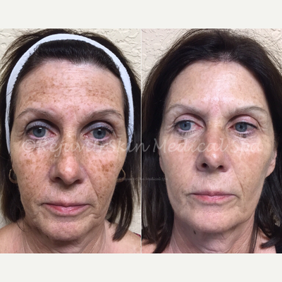 65-74 year old woman treated with SkinPen - Client treated with 1 IPL treatment and 1 SkinPen micro-needling, before photo September, after photo November.