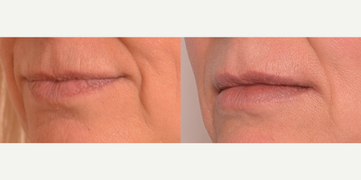 55-64 year old woman treated with threads and filler - This woman was treated with upper lip threads and Volbella for less lines and a natural looking lip lift and fullness.