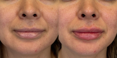 34 year old woman treated with Restylane Defyne on lips - This beautiful young lady was given 0.5cc of Restalyne Defyne on her lips for a nice freshly rejuvenated plumped up look to her lips!