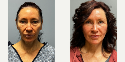 45-54 year old woman treated with Deep Plane Facelift, Facial Fat Transfer, Renuvion, Laser Resurfacing - Patient had a deep plane facelift with Renuvion + CO2 laser skin resurfacing for added skin tightening combined with facial fat grafting to restore natural anatomy. Additional procedures include upper and lower eyelid blepharoplasty.
