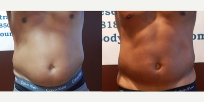 35-44 year old man treated with LED Light Therapy - Treatment with Ultraslim, before and after.
