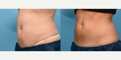 45-54 year old woman treated with Cryolipolysis - One session of CoolSculpting at Wise Med Spa was all it took to give this patient the definition she was looking for in her abdomen. Three months post-treatment, she couldn't be happier with her slimmer appearance!