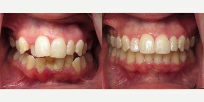 25-34 year old woman treated with Six Month Smiles - Nichole was unhappy with her crooked smile and chose to have Six Month Smiles (6MS) short term orthodontics done with Dr. Jason Tubo. This was an Advanced 6MS case requiring the use of the Solea CO2 laser and a removable expander to help give Nichole a wider prettier smile. Straightening the teeth makes it easier to keep them clean, so the end result is not just a beautiful smile, but healthier gums and whiter teeth are the happy side effects of this treatment too!
