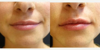 25-34 year old woman treated with Restylane Refyne - The patient had a lip augmentation with Restylane Refyne. A new product that has less swelling and lasts longer! All of my patients wish they had a lip filler that lasts longer and now they have more options. Restylane Refyne is a great product that lasts up to a year. It is designed for patients that want a product that will last longer but still give them a subtle yet lasting result for their lip augmentation.