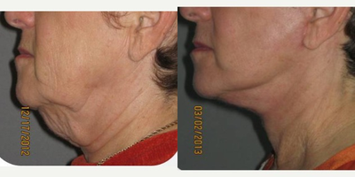 55-64 year old woman treated with Neck Lift - This middle-aged woman presented with a unsightly turkey neck which caused her much embarrassment and had led to social isolation.  We performed a necklift and SMAS facelift on her to tighten both the underlying muscle of her neck/jowls and facial skin.  Her result demonstrates significant improvement in her neck and jawline without pulling her the corners of her mouth or earlobes leading to a very natural result.  Her procedure was performed under local anesthesia and oral sedation with valium, and her recovery time was about a week.