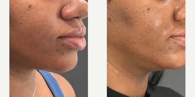 Woman treated with SkinPen, VI Peel - This client wanted to improve her skin texture, pores, and hyperpigmentation so we did a series of 1 SkinPen Microneedling, 1 Vi Peel Precision Plus, and 1 Hydrafacial 4 weeks apart between treatments!