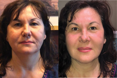 Woman treated with TempSure - Woman treated with TempSure.The results are after 1 treatment.