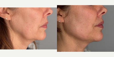45-54 year old woman treated with Radiesse - patient treated with 2 syringes of radiesse for jawline lift and contour