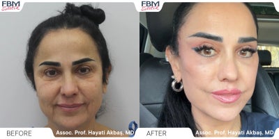 45-54 year old woman treated with Facelift, Deep Plane Facelift, Neck Lift, Lip Lift, Facial Fat Transfer, Eyelid Surgery, Canth - 45-54 year old woman treated with Facelift, Deep Plane Facelift, Neck Lift, Lip Lift, Facial Fat Transfer, Eyelid Surgery, Canthoplasty