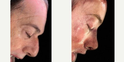 Patient treated with Cheek Implants, Rhinoplasty, Brow Lift - An important profile transformation from last weeks OR. Procedures performed: forehead contouring, browlift, hairline advancement, rhinoplasty, mandible contouring with sliding genioplasty, cheek implants, lip lift with lip augmentation. Thank you for being willing to share your photos!